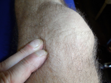 Friktionsmassage am Knie